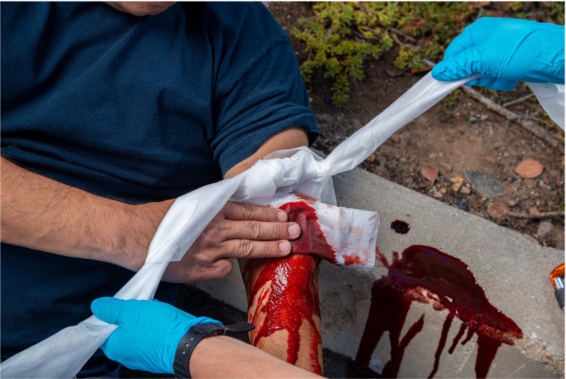 Patient with a bleeding wound on the arm being bandaged