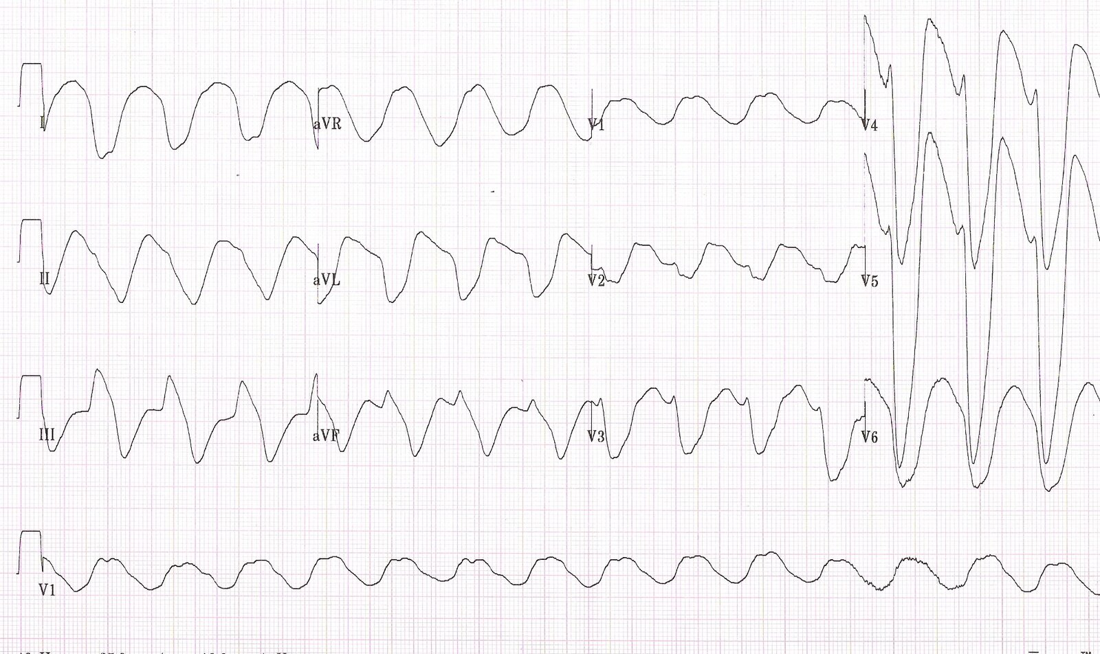 Hyperkalaemia ECG showing a sine wave morphology