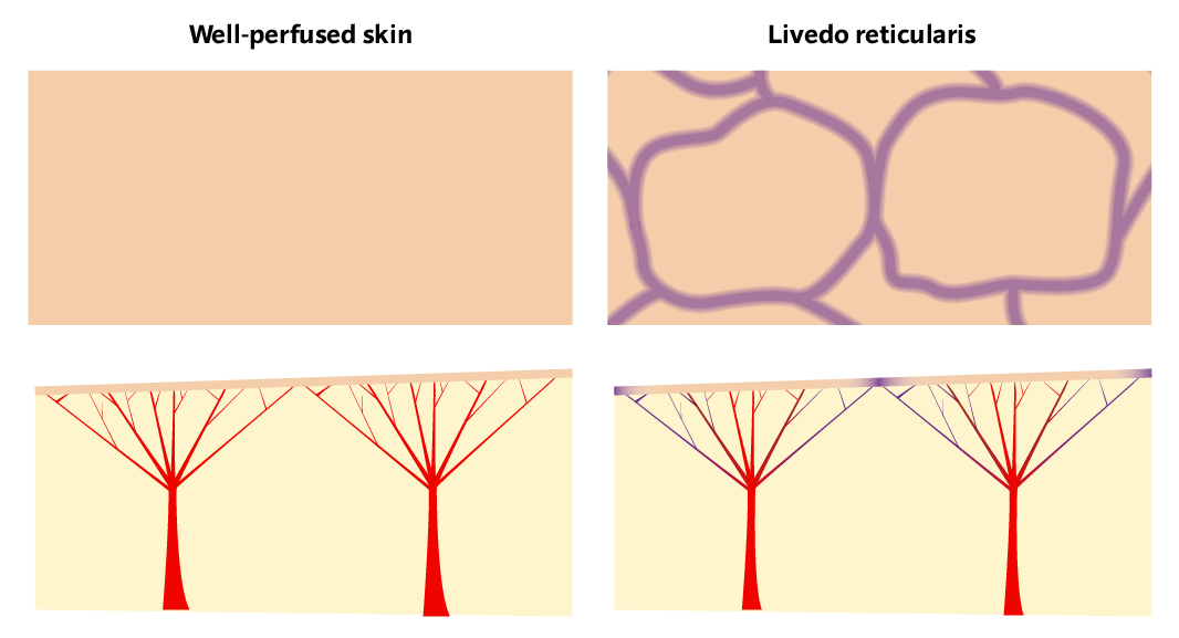 livedo reticularis pathogenesis