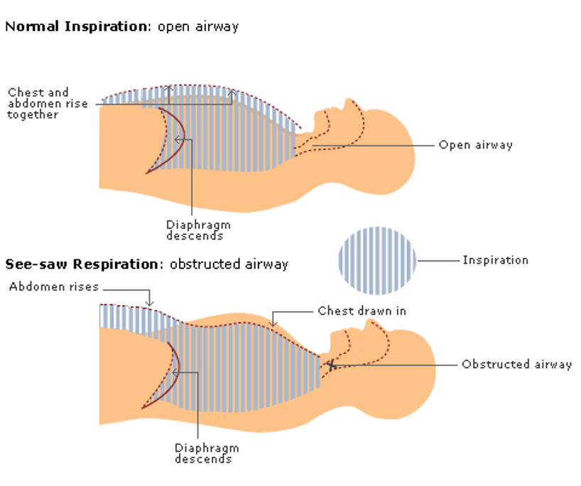 Graphic depicting normal and see-saw respiration