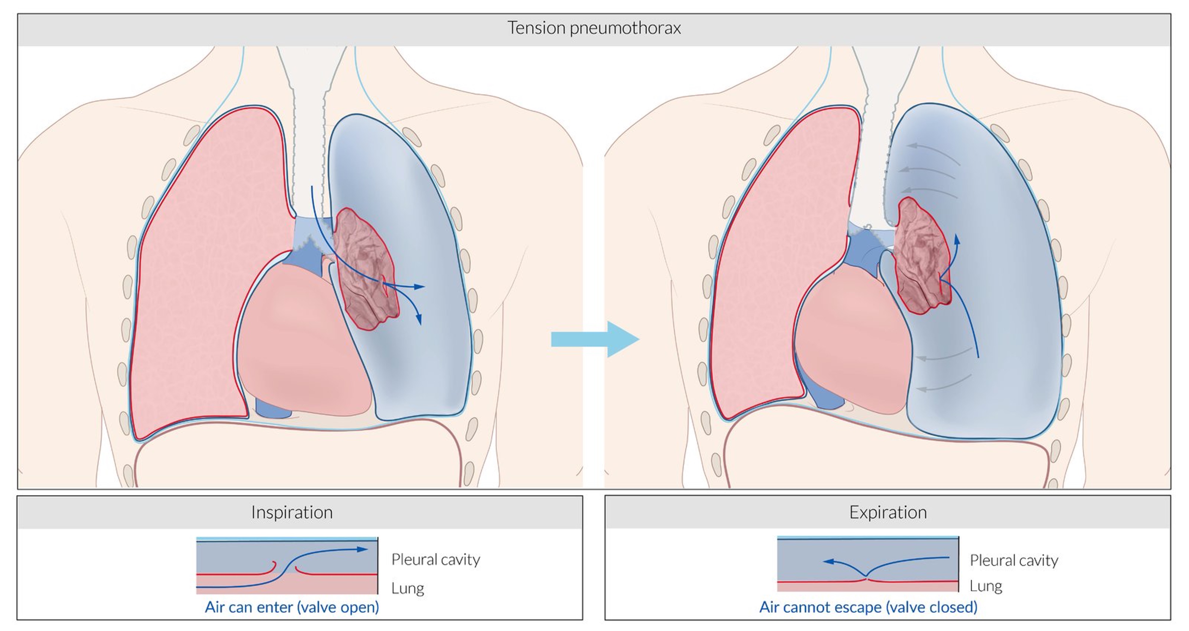 Pathogenesis of tension pneumothorax