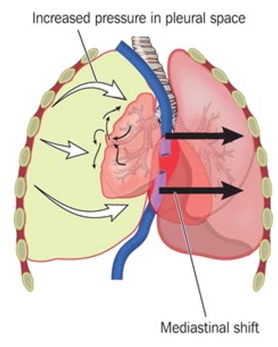 Graphic depicting mediastinal shift in tension pneumothorax