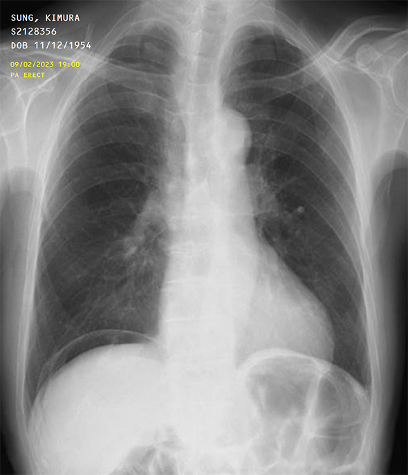 Chest X-Ray for Kimura Sung