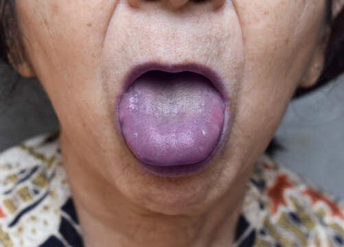 Blue discolouration of the tongue and lips seen in central cyanosis