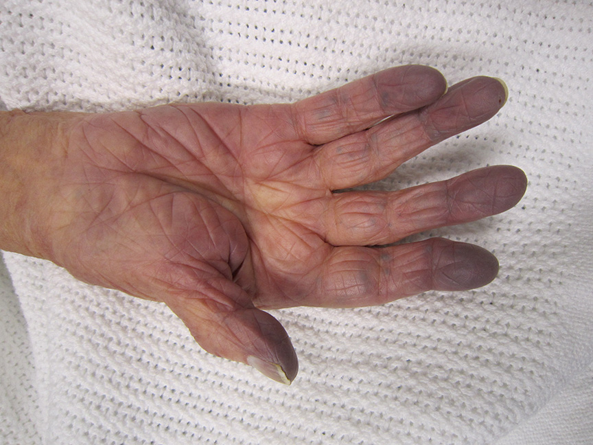 Blue discolouration of the fingertips seen in peripheral cyanosis